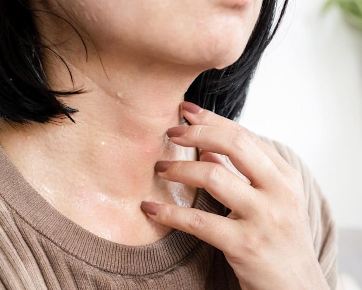 Suffering from eczema? 7 ways you can cope with the worsening heat and humidity