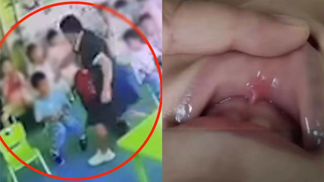 网传幼儿园教师剪破多童上颚 中国当局展开调查