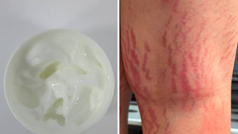 HSA warns against 3 products after consumers, including a 12-year-old, suffer serious health effects