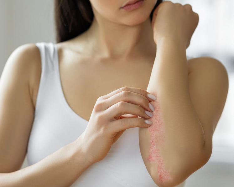 Cara kenal pasti jika ruam gatal adalah psoriasis dan bukannya ekzema. Apakah rawatannya? 
