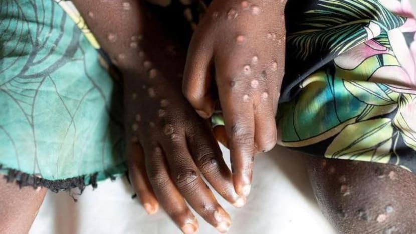 WHO: Mpox bukan COVID baru, Kemenkes siapkan 4 ribuan dosis vaksin WHO: Mpox bukan COVID baru, Kemenkes siapkan 4 ribuan dosis vaksin