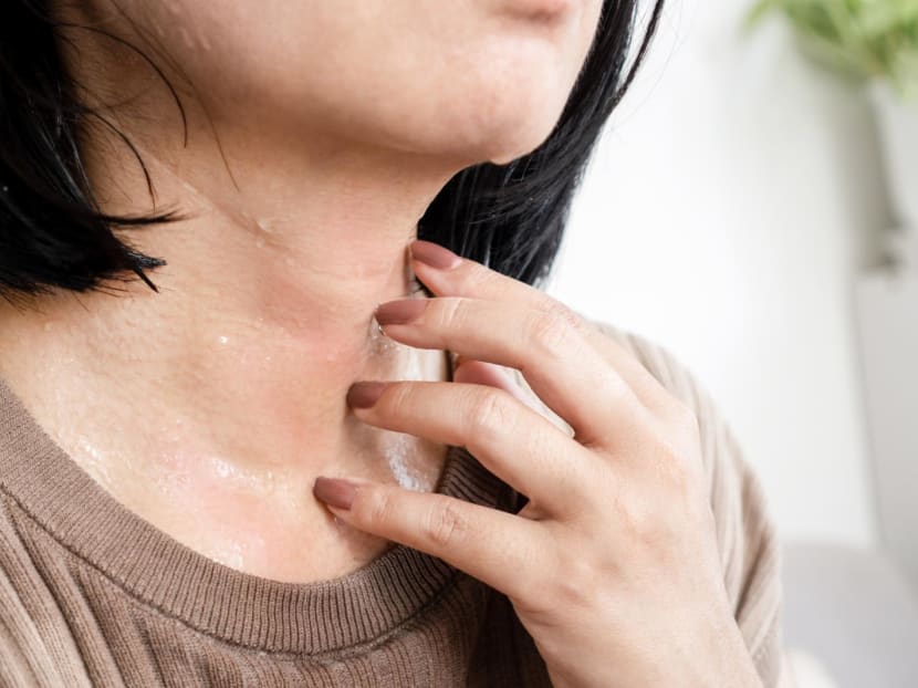 Suffering from eczema? 7 ways you can cope with the worsening heat and humidity