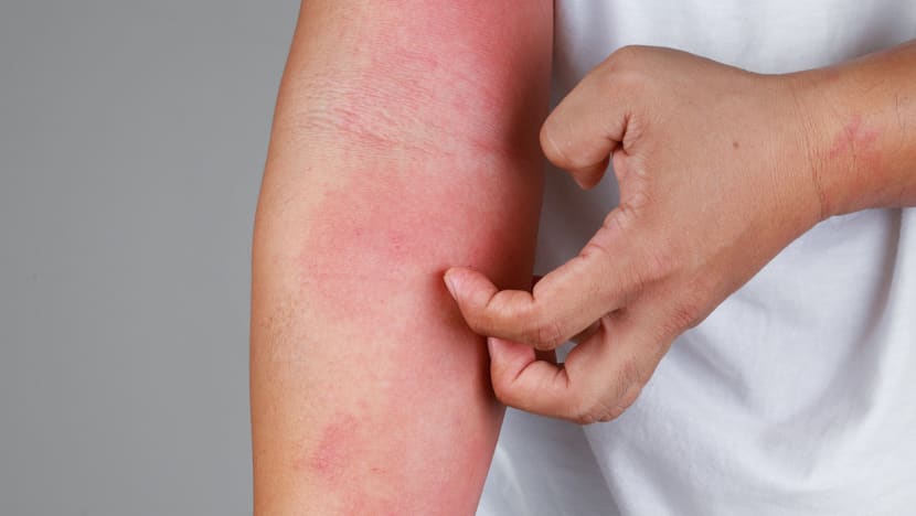 Patient given immunosuppressant for rash hospitalised for serious side effects; doctor suspended