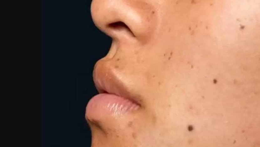 Wanita China maut selepas jalani rawatan buang bintik hitam, tanda lahir di hospital privet