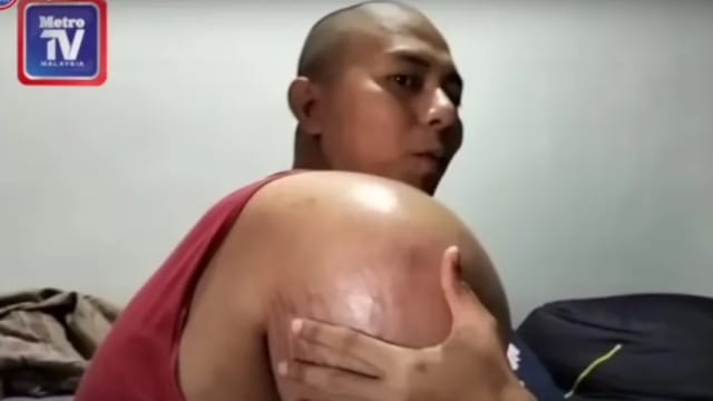 医生误判骨肉瘤为肩周炎 马国男子三角肌肿大如球