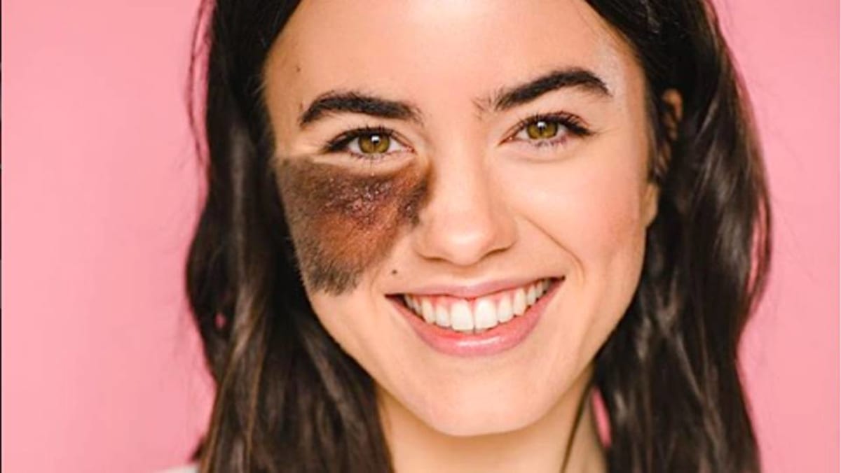 Living with birthmarks: What are the ones you can and cannot remove - CNA  Lifestyle