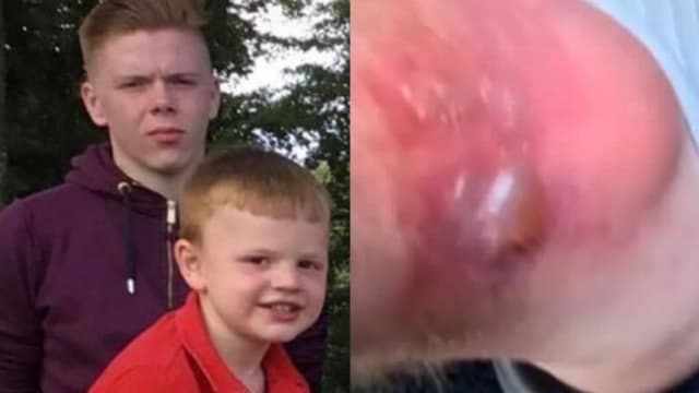 触碰最危险植物 英国男子起大水泡无法行走