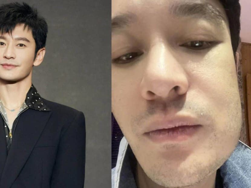 Huang Xiaoming Shows How Square His Jawline Is After Wisdom Tooth Swells Up