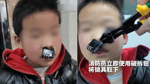 中国男童玩耍出意外 密码锁套住鼻梁卡死