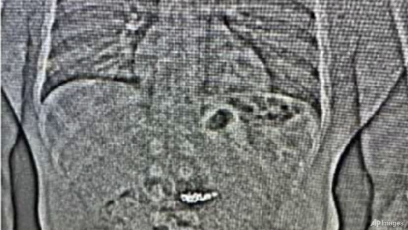 X-ray shows US$770,000 diamond earrings swallowed by theft suspect during arrest: US police X-ray shows US$770,000 diamond earrings swallowed by theft suspect during arrest: US police
