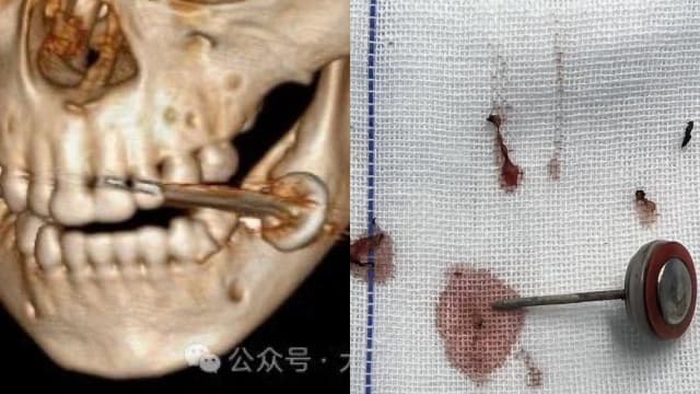电池放嘴里咬引发爆炸 中国两岁童紧急送院
