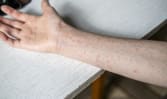 CNA Explains: Is Singapore at risk of a measles comeback?