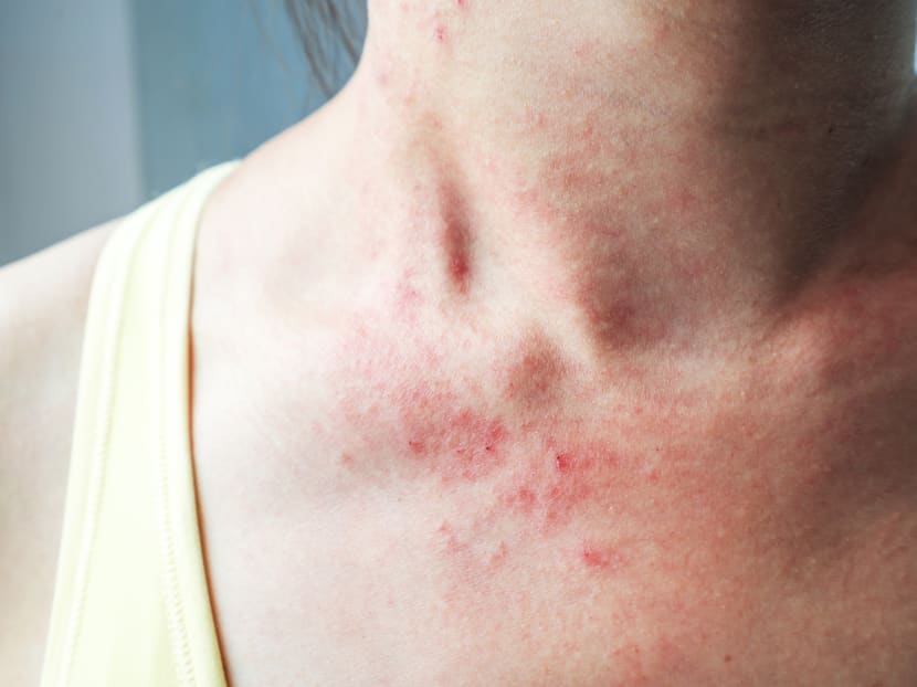 It is not just a childhood disease. Eczema, the top skin condition seen by the National Skin Centre, can make life miserable for adults. It is not just a childhood disease. Eczema, the top skin condition seen by the National Skin Centre, can make life miserable for adults.