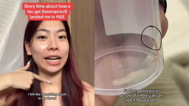 豆芽卡喉咙！女子饭后无法取出异物挂急诊求医