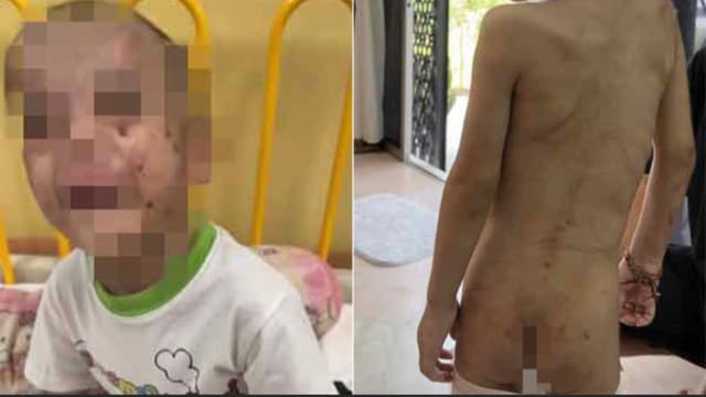 疑遭保姆虐待 马国男童变皮包骨全身伤 母崩溃报案