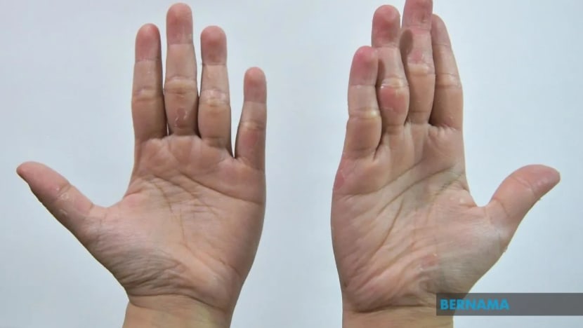 Pahang catat rekod 1,145 kes HFMD, naik 6 kali ganda berbanding 2021 