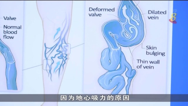静脉曲张恶化恐患静脉血栓症 医生：应多走动
