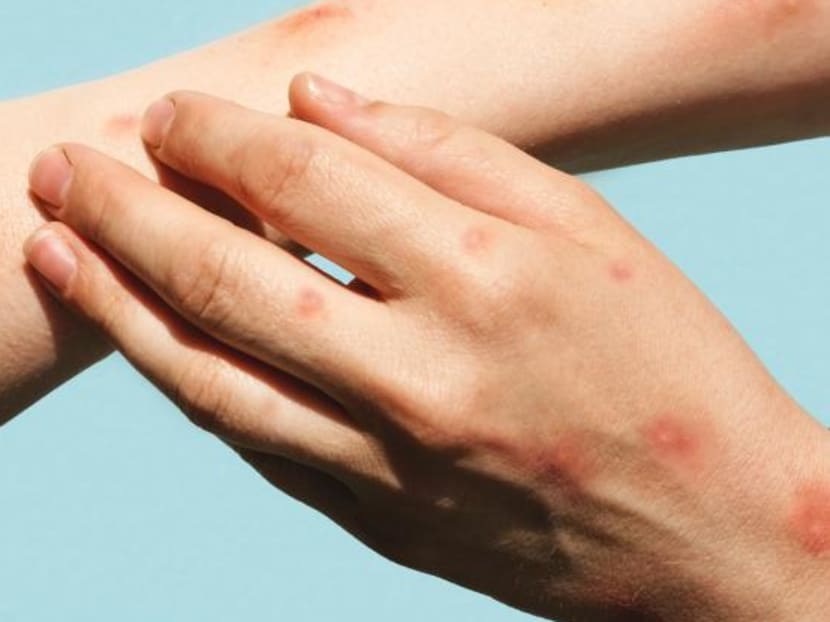 Monkeypox, chickenpox or shingles? Infectious diseases experts explain the difference Monkeypox, chickenpox or shingles? Infectious diseases experts explain the difference