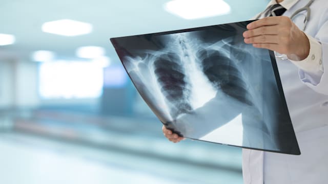 柔佛哥打丁宜现肺结核感染群 804人筛查33人确诊