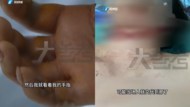 被风筝线“割喉” 中国女子一个动作捡回一命