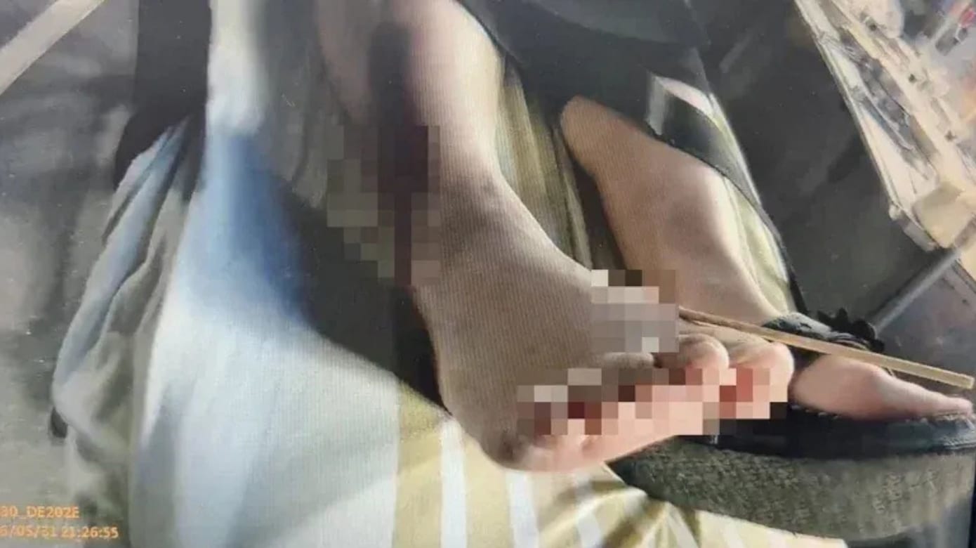 台湾女子穿夹脚拖逛夜市 不慎踩中竹签脚部遭刺穿