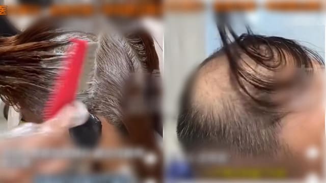 一个月染发四次 中国男子十多天掉光头发