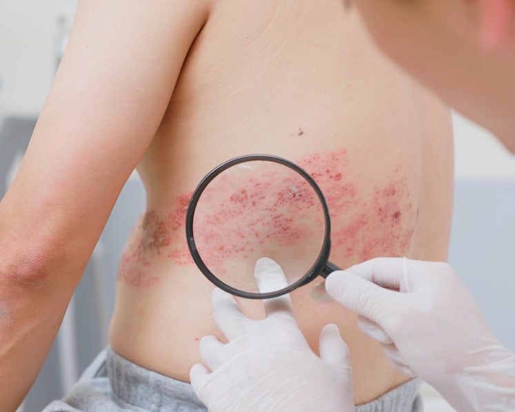 Shingles vaccine linked to fewer heart attacks and strokes, study suggests – what you need to know