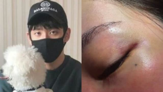 Jisoo大嫂晒瘀青照，控告遭老公家暴！