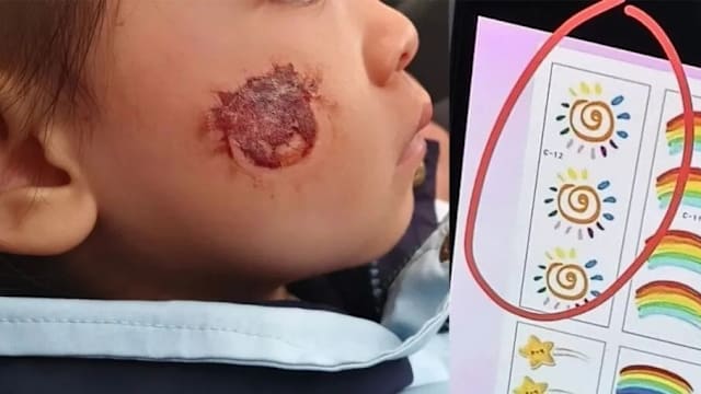 参加幼儿园活动贴卡通贴纸 湖南三岁女脸部糜烂结痂