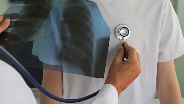 马来西亚多数肺结核病例涉及当地人