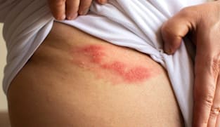 Shingles: More than a rash, a painful condition not to ignore 