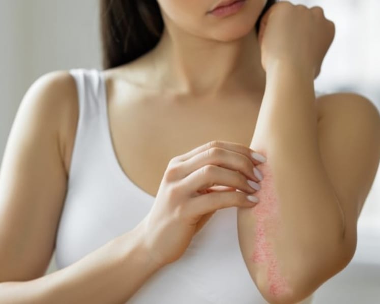 Jika ruam gatal di kulit Anda ternyata psoriasis dan bukan eksim, apa yang dapat dilakukan?