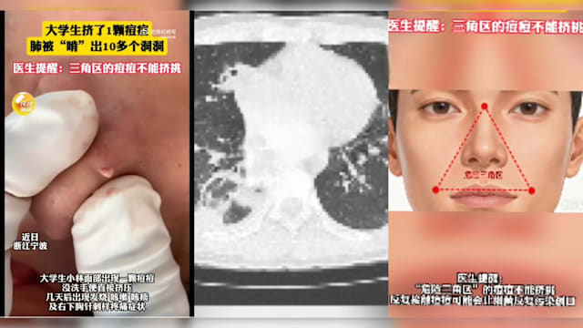 挤痘痘险丢命！中国20岁男生肺感染细菌被“啃”出十多个空洞