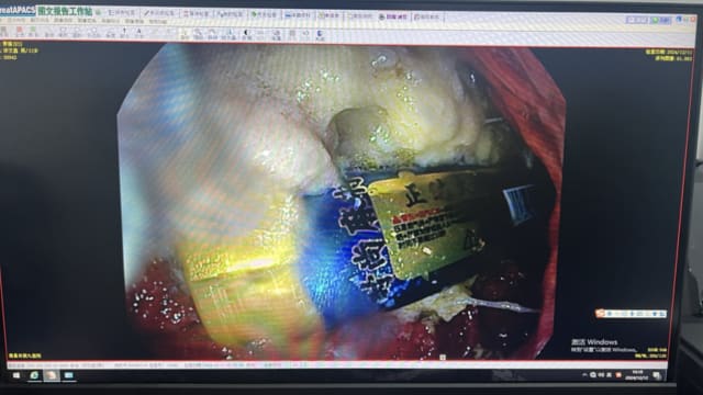 误吞九公分打火机 中国男子腹部剧痛送医取出