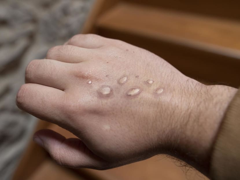 Singapore confirms imported case of monkeypox after flight attendant develops fever and rashes