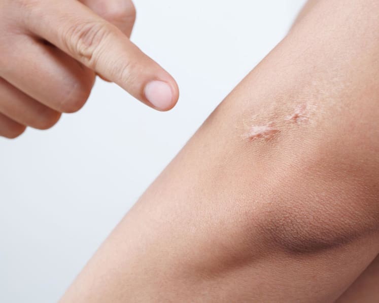 Can you make scars fade? Doctors explain why they form and what works – from silicone sheets to Vitamin E