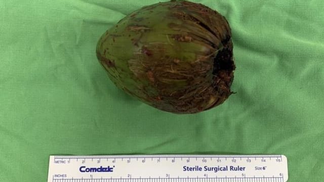 为求刺激竟把椰子塞肛门 台男子腹痛求医