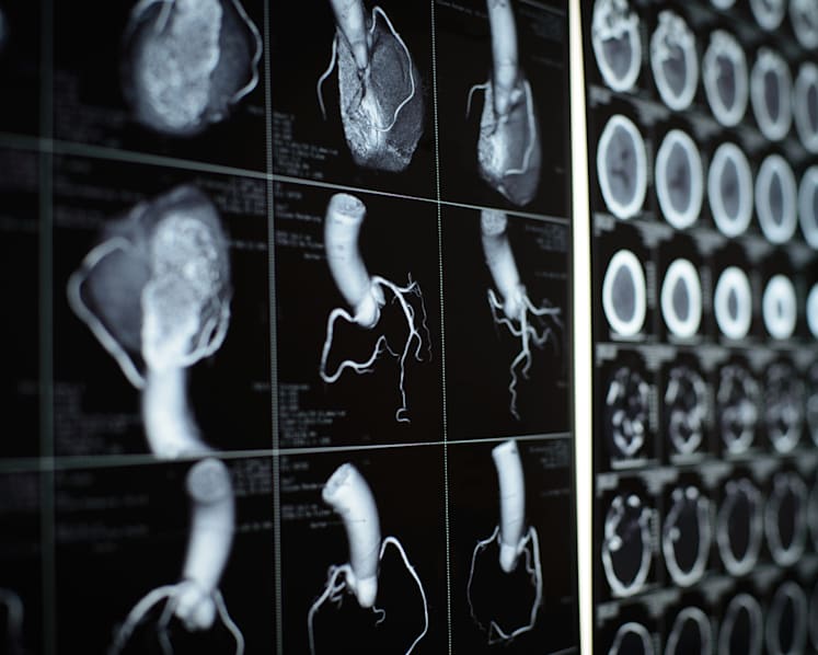 Commentary: Long COVID patients are much more likely to have multiple organ abnormalities