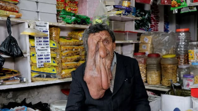“我的脸在渐渐融化”患上罕见疾病印度男子失去右边眼口鼻