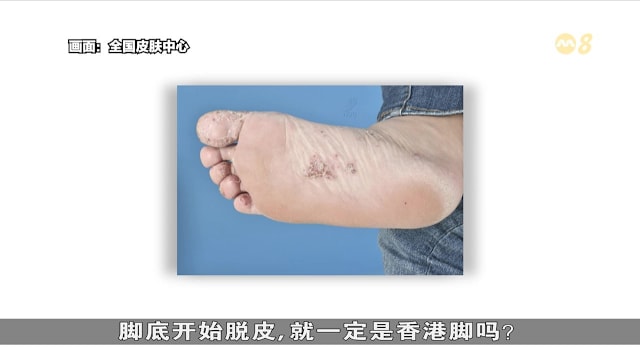 狮城有约 | 指甲变厚就是灰指甲？脚底脱皮未必是香港脚