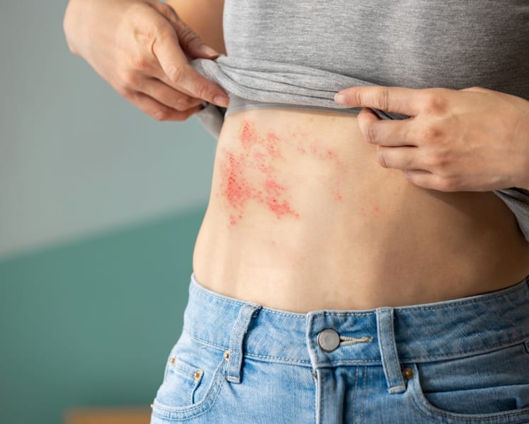 Why shingles hits harder with diabetes