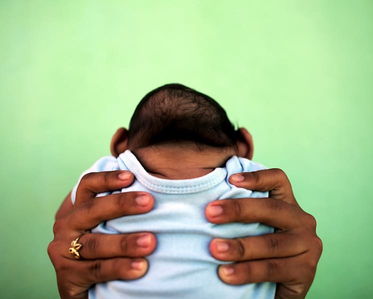 Low risk of Zika-related birth defects, say doctors