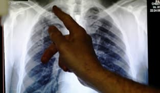 Commentary: We’re losing ground in the global fight against tuberculosis