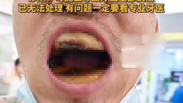 花9角网购材料自补牙 中国男子牙齿被包裹成“烤年糕”