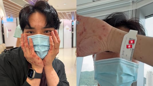 Severe Allergic Reaction To Suspected Insect Bites Lands TVB Actor In Hospital During Holiday In France