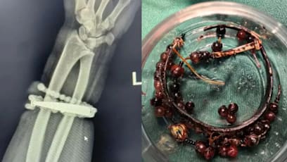 Woman’s Bracelet Gets Lodged In Her Flesh After Wearing It For 10 Years, Causing Severe Infection