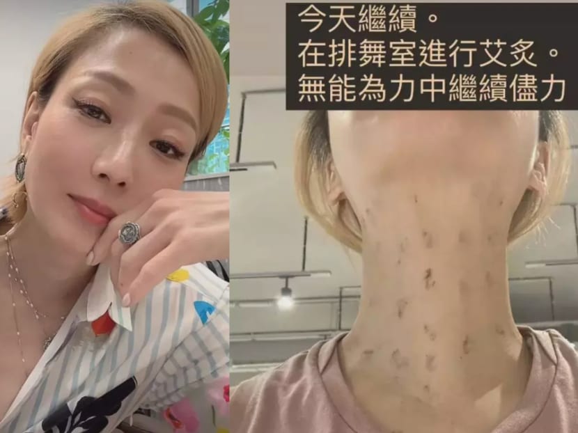 Sammi Cheng shares picture of neck after TCM therapy, says she’s “willing to eat toads” to regain her voice
