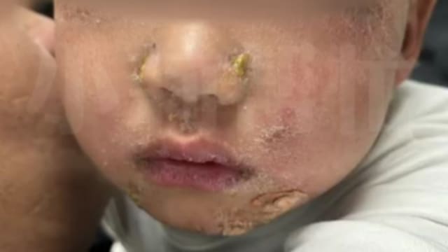 中国三岁童吃火锅烫伤 三天后全身溃烂