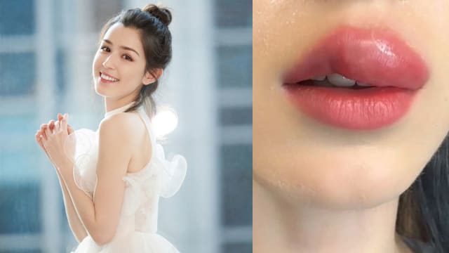 被蚊子叮咬肿成香肠嘴　哈妮克孜“变鸭子”让工作人员爆笑