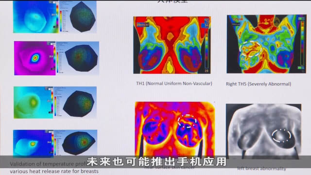 研究团队研发便携式AI乳腺检测工具 快速识别乳房中潜在恶性肿瘤